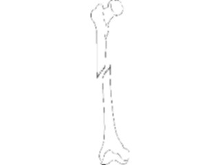 Sticker Custom Preview Image #014726 Anatomy Leg Oblique Fracture